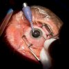 See Clearly Sooner: Why UK Patients Are Choosing Egypt for Cataract Surgery