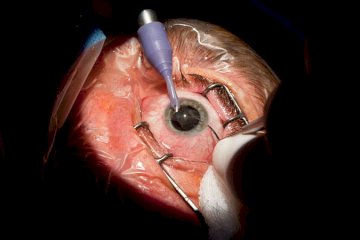 See Clearly Sooner: Why UK Patients Are Choosing Egypt for Cataract Surgery