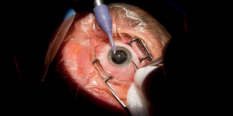 See Clearly Sooner: Why UK Patients Are Choosing Egypt for Cataract Surgery