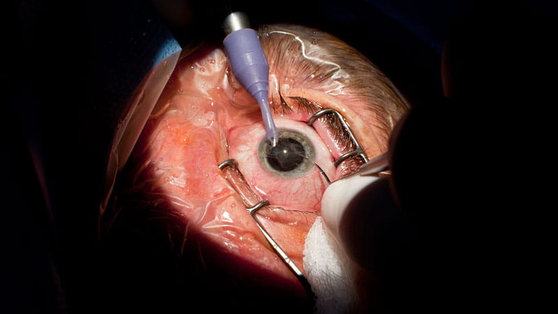 See Clearly Sooner: Why UK Patients Are Choosing Egypt for Cataract Surgery
